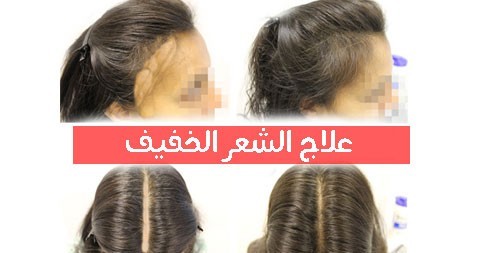 علاج الشعر الخفيف بخلطات منزلية طبيعية ٩ وصفات مفعولها أكيد