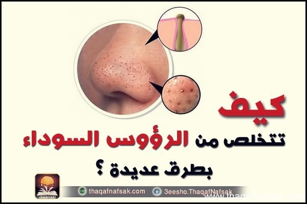 بالصور كيفية ازالة الرؤوس السوداء نهائيا ١٣ طريقة منزلية فعالة