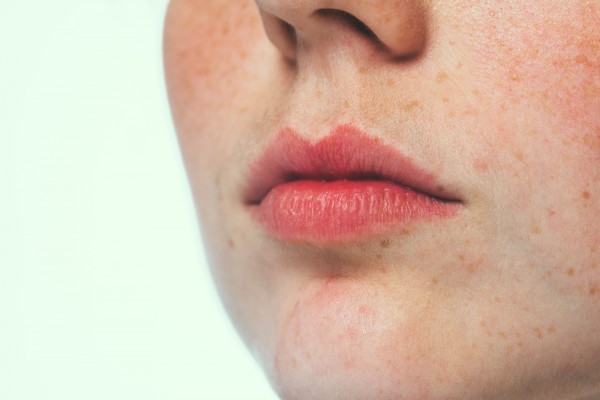طرق التخلص من النمش إليكم علاج النمش مع ١٠ خلطات منزلية سهلة