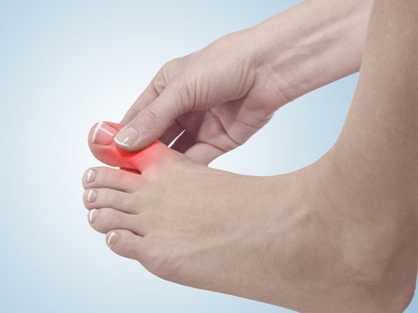 إرتفاع حمض اليوريك الأسباب والعلاج إرتفاع حمض اليوريك الأسباب والعلاج