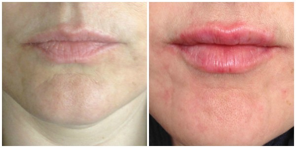 طرق سريعة للتخلص من تجاعيد الشفاه