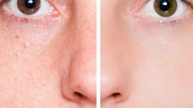 تضيق المسام الواسعة خطوة بخطوة