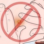 بالصور خطوات علاج الخراج في البيت بطرق طبيعية في زمن قياسي