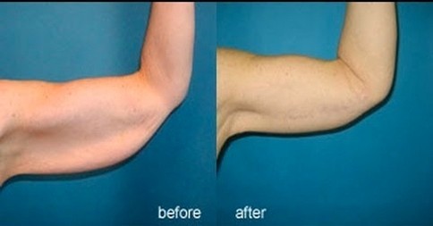 بالصور تمارين بسيطة للتخلص و شد ترهل الذراعين في أسبوع