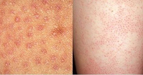 أسباب تقرن و التهاب بصيلات الشعر وعلاجه