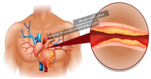علاج الكولسترول المرتفع في الدم أكبر موسوعة مفيدة لك