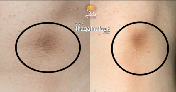 ٧ طرق سريعة تخلصك نهائي من إسمرار الركب ٧ طرق سريعة تخلصك نهائي من إسمرار الركب