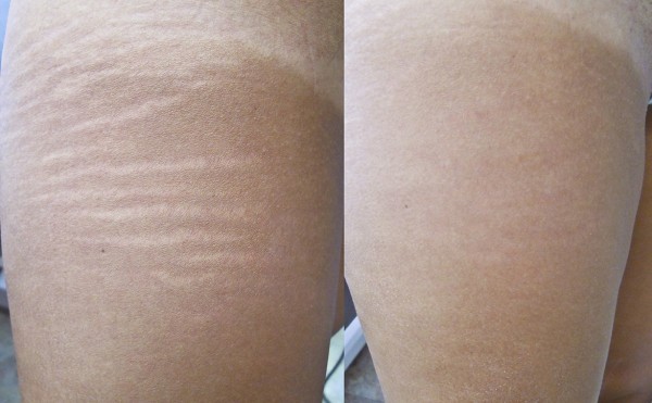 هل الليزر هو افضل علاج للتخلص من علامات التمدد ( الخطوط الببيضاء) في جسمك.