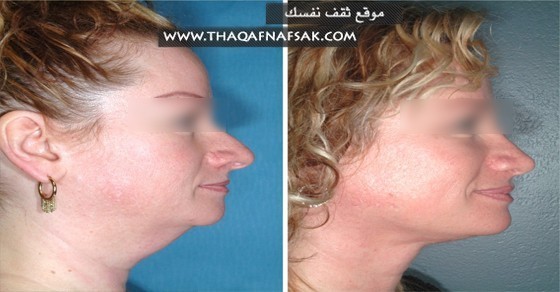 تخسيس دهون الرقبة و الذقن بوصفات منزلية تخسيس دهون الرقبة و الذقن بوصفات منزلية