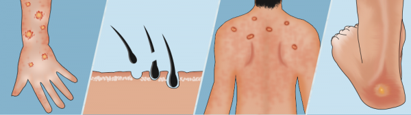 المشاكل الجلدية الشائعة المرتبطة بمرض السكري