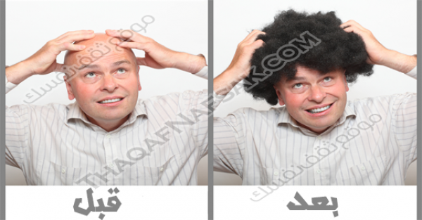 أسباب وعلاج الصلع ٢٠ طريقة لعودة الشعر من جديد أسباب وعلاج الصلع ٢٠ طريقة لعودة الشعر من جديد