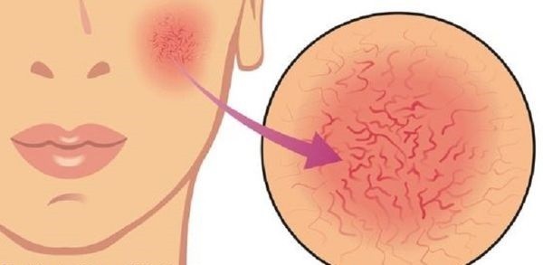 طرق التخلص من الشعيرات الدموية الظاهرة في الوجه