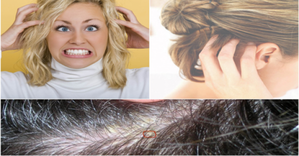 علاج الحكة في فروة الرأس بخلطات من الطب البديل