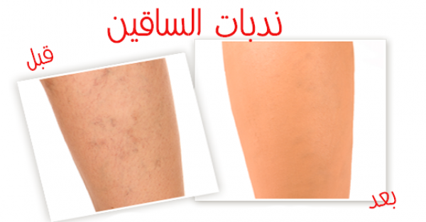 ندبات و بثور الساقين طرق علاجها طبيعيا بالصور