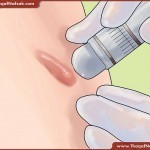 ندبات و بثور الساقين طرق علاجها طبيعيا بالصور