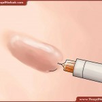 ندبات و بثور الساقين طرق علاجها طبيعيا بالصور