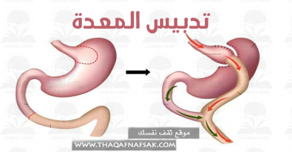 ماهي عملية تدبيس المعدة وأنواعها مضاعفتها وكل شئ عنها ماهي عملية تدبيس المعدة وأنواعها مضاعفتها وكل شئ عنها
