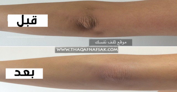 ١٢ خلطة تحقق تبيض وتفتيح الكوعين ١٢ خلطة تحقق تبيض وتفتيح الكوعين
