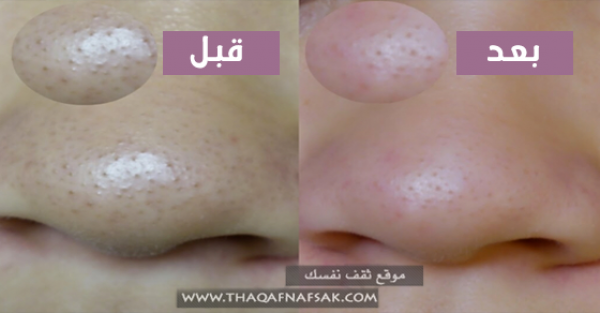١٠ خلطات لتضيق المسام الواسعة وتنظيفها ١٠ خلطات لتضيق المسام الواسعة وتنظيفها