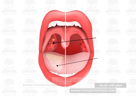 إلتهاب اللسان أسبابه وعلاجه في المنزل