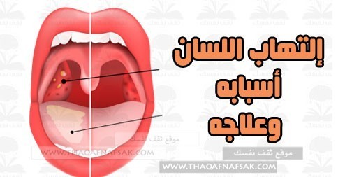إلتهاب اللسان أسبابه وعلاجه في المنزل إلتهاب اللسان أسبابه وعلاجه في المنزل