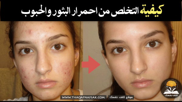 كيفية التخلص من احمرار البثور والحبوب كيفية التخلص من احمرار البثور والحبوب