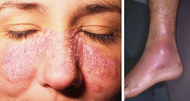 أسباب وأعراض مرض الذئبة وطرق علاجه والوقاية منه