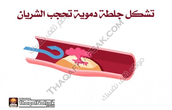 احذر من أسباب وأعراض النوبة القلبية احذر من أسباب وأعراض النوبة القلبية