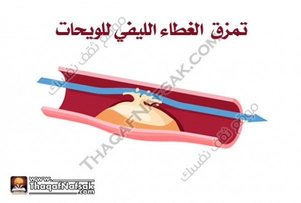 احذر من أسباب وأعراض النوبة القلبية احذر من أسباب وأعراض النوبة القلبية
