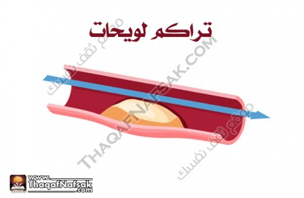 احذر من أسباب وأعراض النوبة القلبية احذر من أسباب وأعراض النوبة القلبية