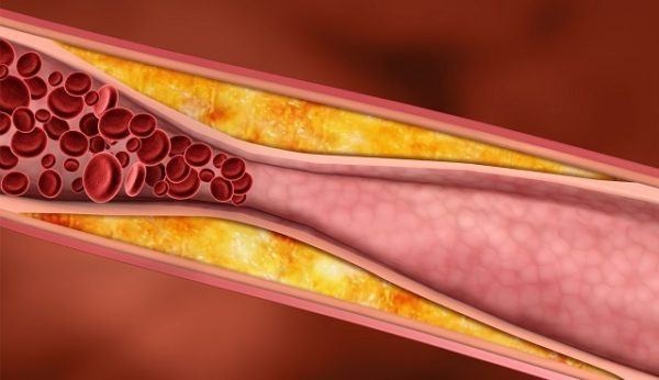 علاج تصلب الشرايين وأمراض القلب بـ 27 علاج منزلي