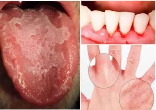 أعراض نقص فيتامين سي ١٢ علامه يجب الحذر منها