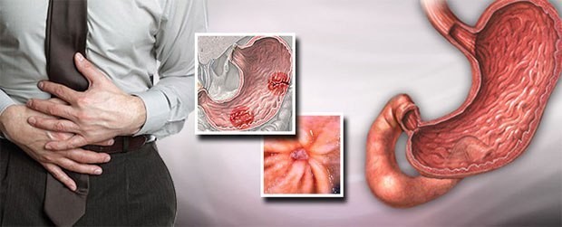 أعراض قرحة المعدة التي لا يجب إغفالها وطرق علاجها