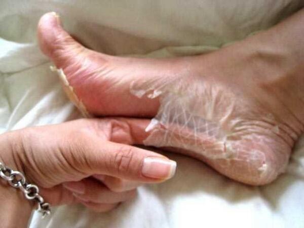 خلطات إزالة الجلد الميت على الجلد