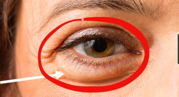 علاج انتفاخ تحت العين بـ ١٨ وصفة