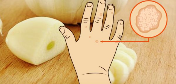 علاج الشامات والثآليل والرؤس السوداء والبقع الداكنة