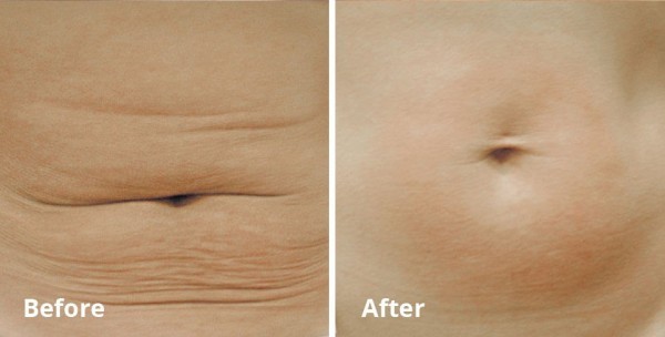 علاج ترهل الجلد بـ ٩وصفات ونصائح فعالة