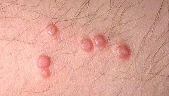 أسباب حبوب الفخذين وعلاجها لتجنب مضاعفتها