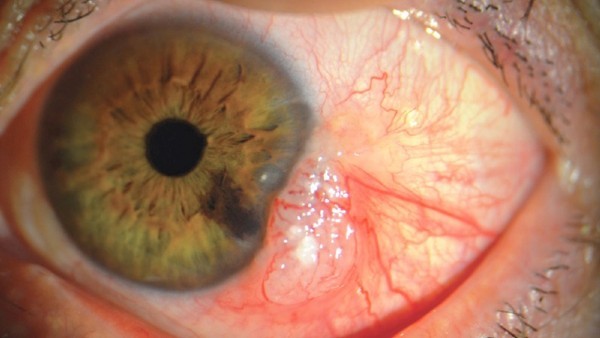 ما الذي يسبب تراكم البروتين في العيون؟