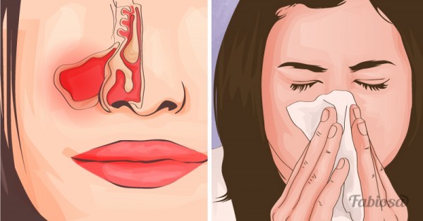 علاج التهاب الجيوب الأنفية في الربيع وطرق الوقاية