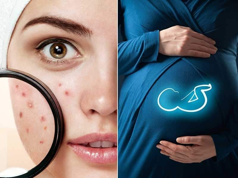 طرق آمنه لعلاج حبوب الشباب أثناء الحمل