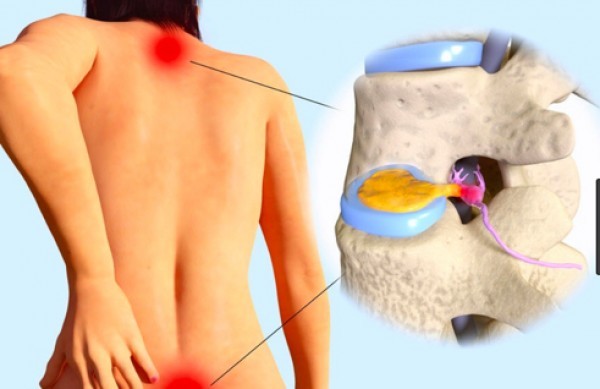 كيف نعالج تشنجات الظهر المؤلمة ؟