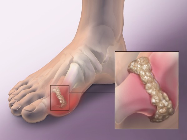 كيف تقلل حمض اليوريك في الدم للحماية من مرض النقرس و علاجه كيف تقلل حمض اليوريك في الدم للحماية من مرض النقرس و علاجه
