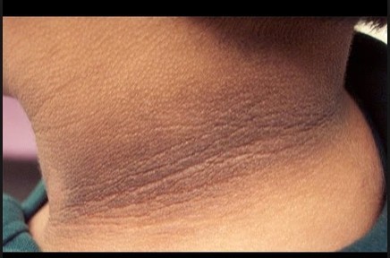 ٨ طرق تعالج سواد الرقبة في يومين