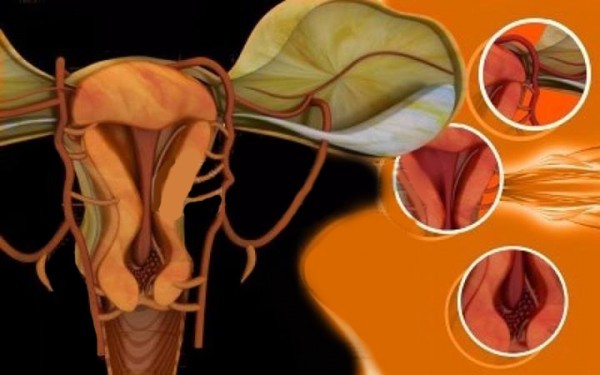 طريقة تنظيف الرحم بالاعشاب