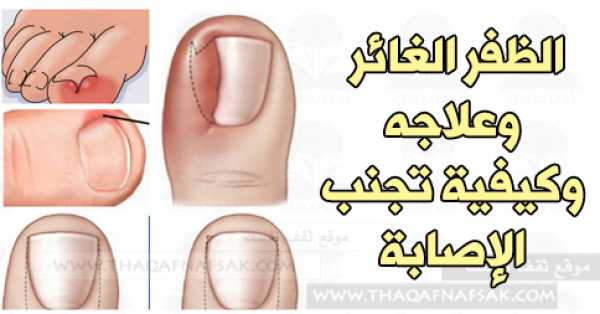 الظفر الغائر وعلاجه وكيفية تجنب الإصابة [الظافر المنغرز ]