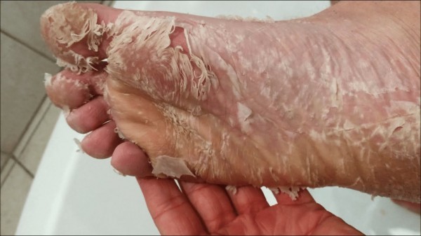 إزالة الجلد الميت في القدم ١٩ وصفة لحل المشكلة