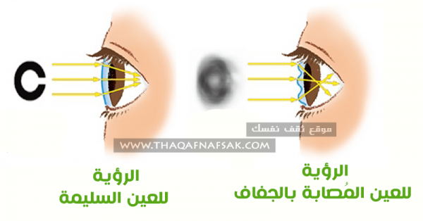 جفاف العين أعراض تؤكد إصابتك به وأسبابه لتتجبنها فوراً