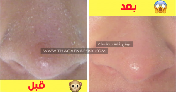 علاج جفاف البشرة ١٨ وصفة ستمنحك بشرة رطبة