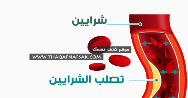 تصلب الشرايين الأعراض، الأسباب والعلاج بـ ٢١ طريقه طبيعيه